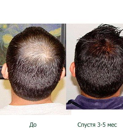 Лосьон для роста волос и бороды Азеломакс форте актив 5% -60мл.